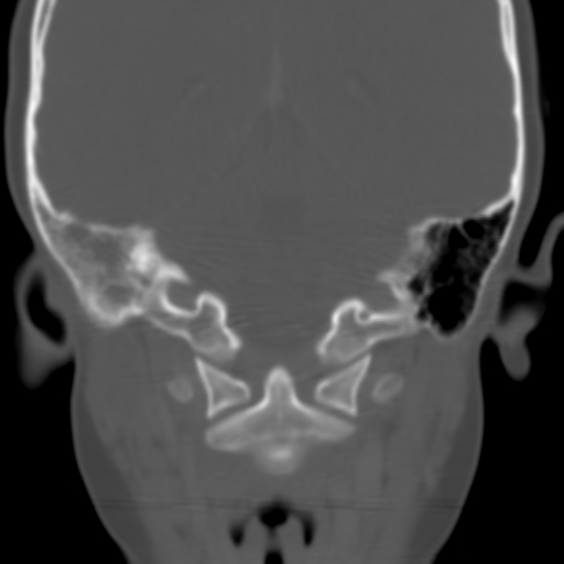 File:Nasopharyngeal rhabdomyosarcoma (Radiopaedia 23417-23491 Coronal bone window 10).jpg