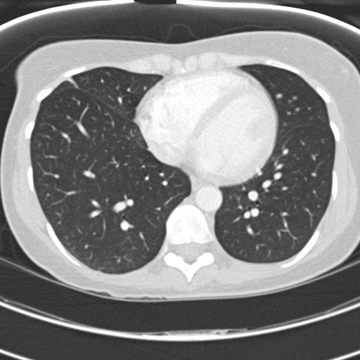Necrobiotic pulmonary nodules - Crohn disease (Radiopaedia 20723-20631 Axial lung window 97).jpg