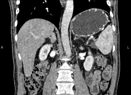 Necrotizing pancreatitis (Radiopaedia 87796-104248 F 41).jpg