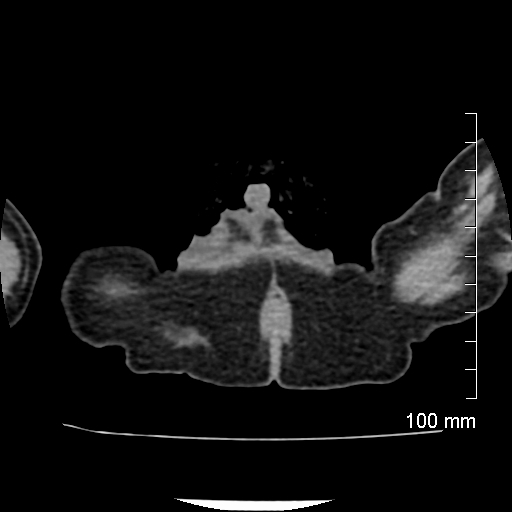 File:Neonatal neuroblastoma (Radiopaedia 56651-63438 Axial non-contrast 95).jpg