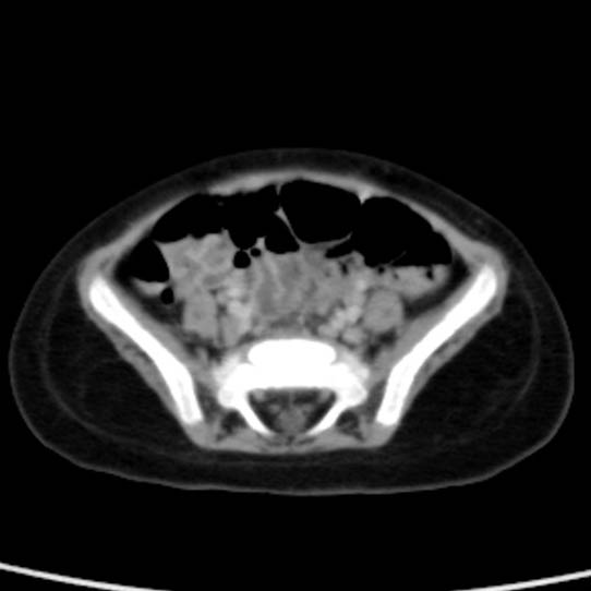 Neuroblastoma with skull metastases (Radiopaedia 30326-30960 C 46).jpg