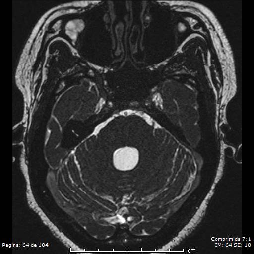 Neurocysticercosis (Radiopaedia 58636-65832 I 64).jpg