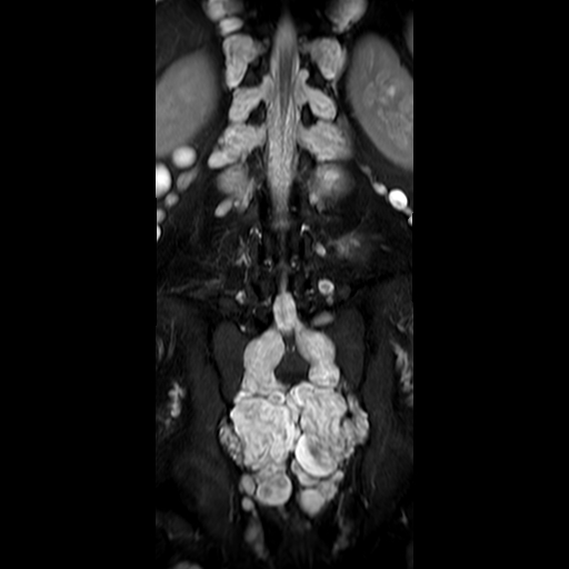 File:Neurofibromatosis type 1- extensive spinal involvement and Christmas tree sign (Radiopaedia 60610-68332 Coronal STIR 12).jpg