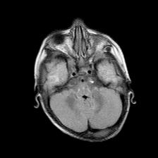 File:Neurofibromatosis type 1 (Radiopaedia 30089-30671 Axial FLAIR 6).jpg
