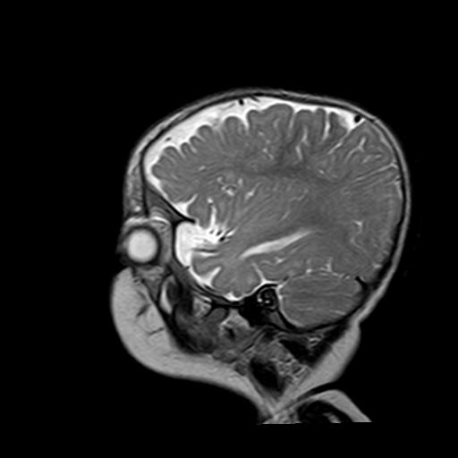 File:Neurofibromatosis type 1 (Radiopaedia 30089-30671 Sagittal T2 16).jpg