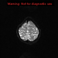 File:Neurofibromatosis type 1 with optic nerve glioma (Radiopaedia 16288-15965 Axial DWI 3).jpg