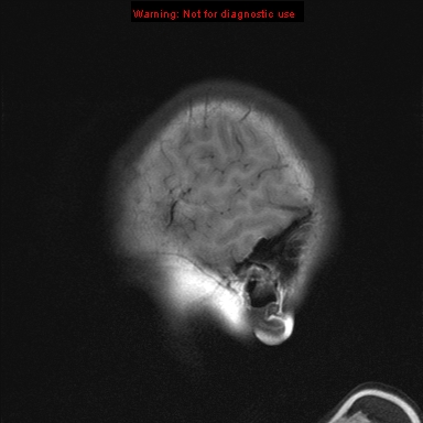 File:Neurofibromatosis type 1 with optic nerve glioma (Radiopaedia 16288-15965 Sagittal T1 22).jpg