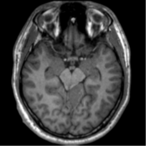 File:Neurofibromatosis type 2 (Radiopaedia 44936-48838 Axial T1 54).png