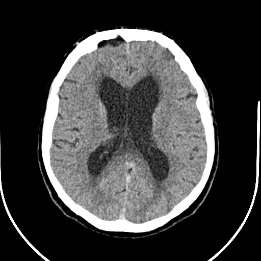 Neurofibromatosis type 2 (Radiopaedia 79097-92047 Axial non-contrast 35).jpg