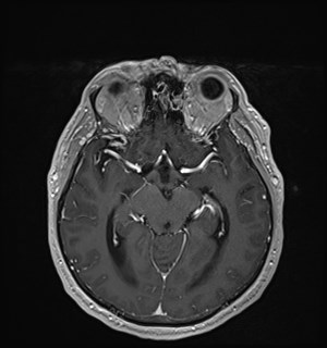 Neurofibromatosis type 2 (Radiopaedia 79097-92049 Axial T1 C+ 89).jpg