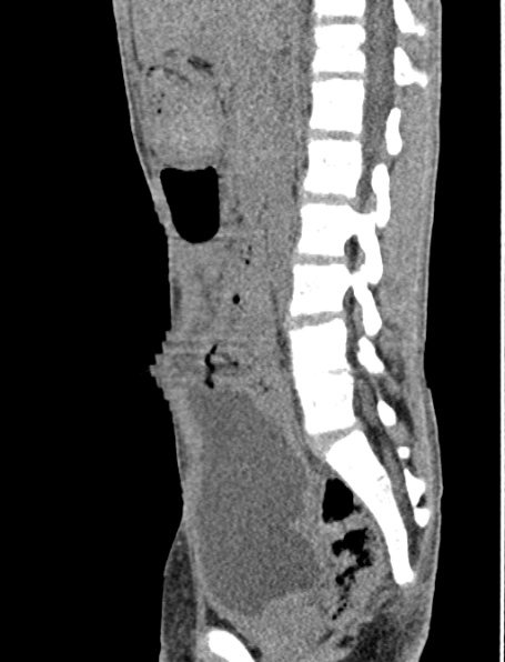 File:Neurogenic bladder (Radiopaedia 29058-29421 Coronal non-contrast 30).jpg