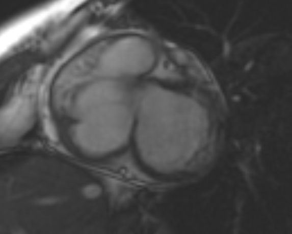 File:Non-compaction of the left ventricle (Radiopaedia 69436-79314 Short axis cine 181).jpg
