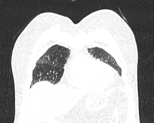 Non-specific interstitial pneumonia (NSIP) (Radiopaedia 68599-78228 Coronal lung window 13).jpg