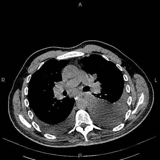 File:Non Hodgkin lymphoma in a patient with ankylosing spondylitis (Radiopaedia 84323-99621 Axial non-contrast 13).jpg