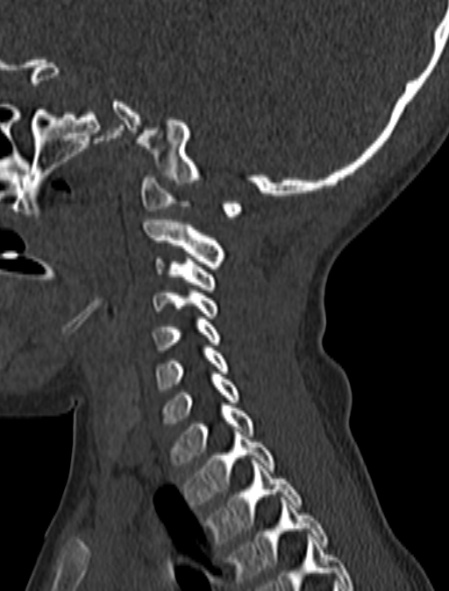 File:Normal CT cervical spine - pediatric (Radiopaedia 52549-58462 Sagittal bone window 58).jpg