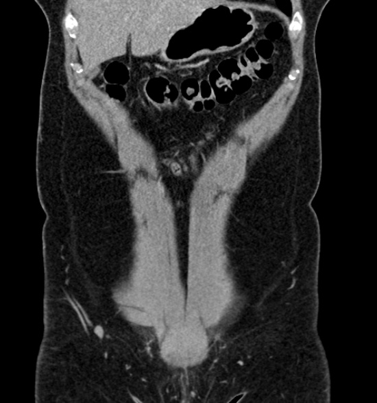 Normal CT intravenous urogram (Radiopaedia 39444-41759 A 190).jpg