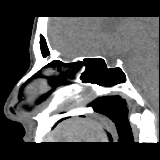 Normal CT paranasal sinuses (Radiopaedia 42286-45390 F 79).jpg