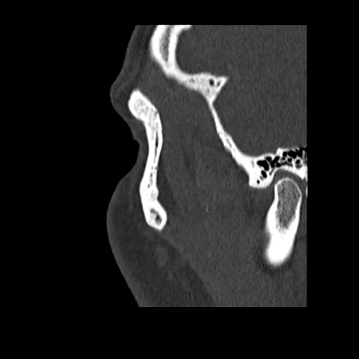Normal CT paranasal sinuses (Radiopaedia 42286-45390 Sagittal bone window 100).jpg