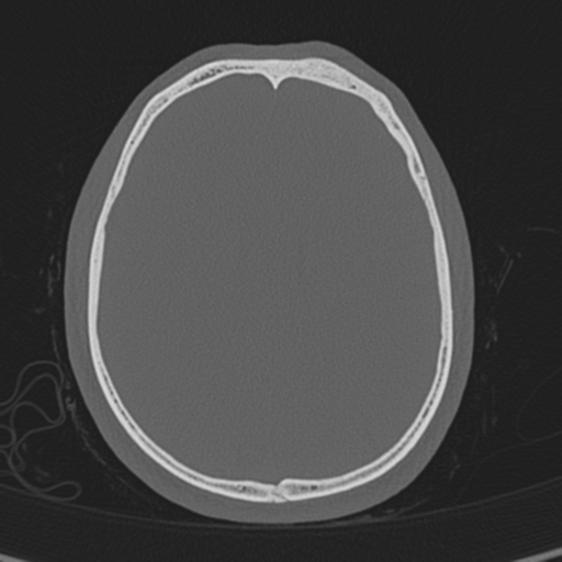 Normal CT skull (Radiopaedia 40798-43459 A 103).png