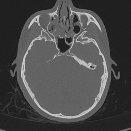 Normal CT skull (Radiopaedia 40798-43459 A 49).png