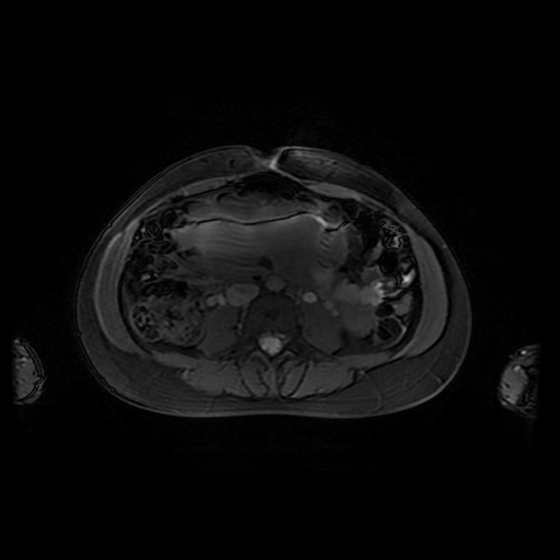 File:Normal MRI abdomen in pregnancy (Radiopaedia 88001-104541 D 30).jpg