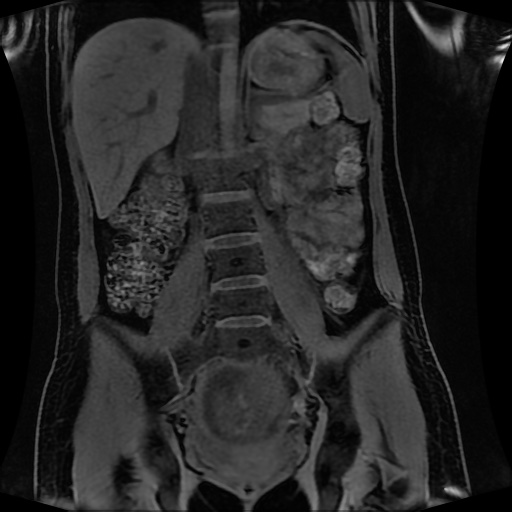 Normal MRI abdomen in pregnancy (Radiopaedia 88001-104541 M 84).jpg
