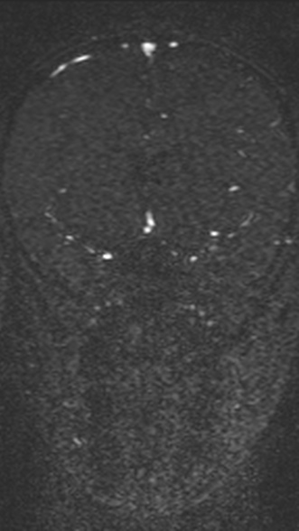 Normal MRI brain with MRV- teenager (Radiopaedia 49425-54553 Coronal MRV 103).jpg