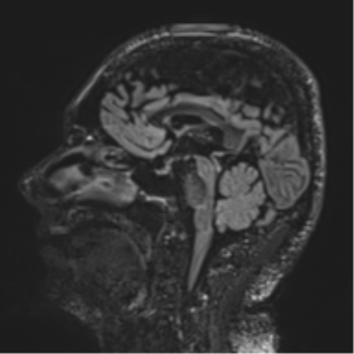 Normal brain MRI (non-focal epilepsy protocol) (Radiopaedia 53917-60040 Sagittal DIR 33).png