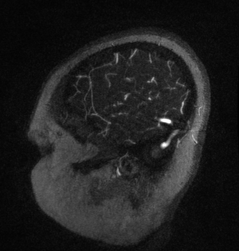 Normal brain MRI and venogram (Radiopaedia 39554-41862 Sagittal MRV 6).jpg