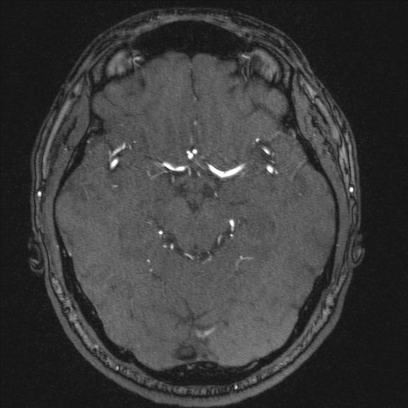 Normal brain MRI including MRA (Radiopaedia 48748-53763 Axial MRA 86).jpg