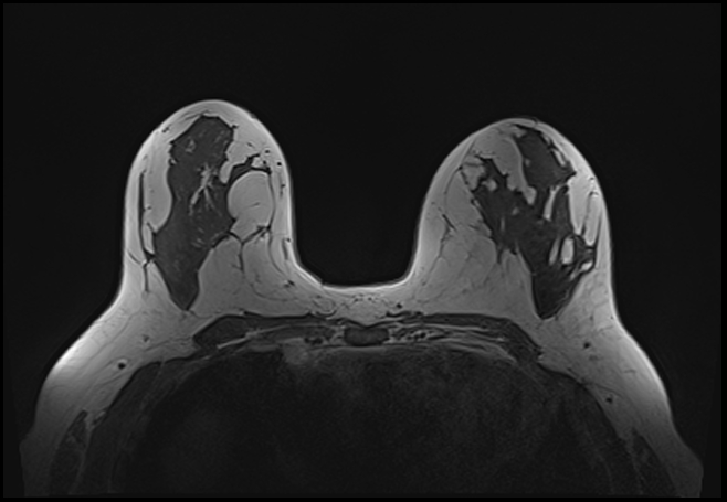 File:Normal breast MRI - dense breasts (Radiopaedia 80454-93850 Axial T1 112).jpg