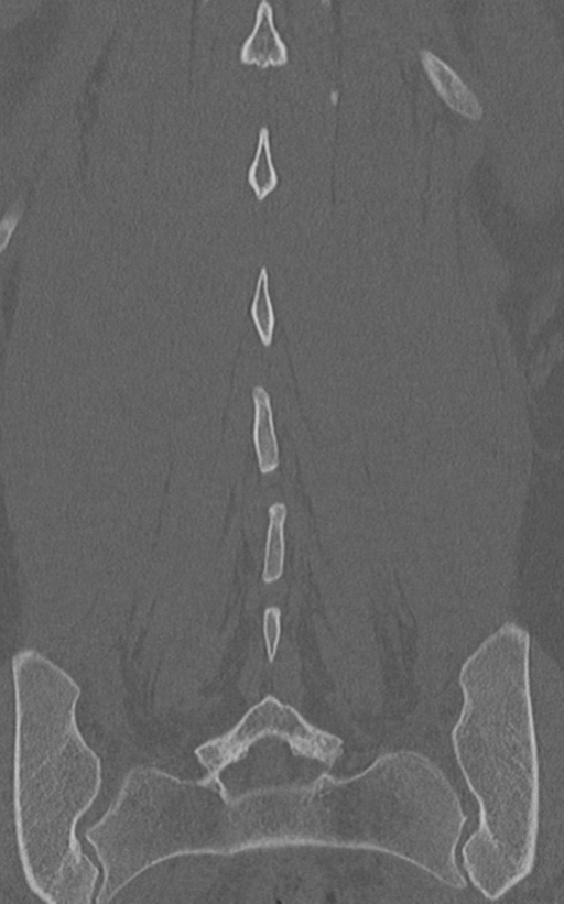 Normal lumbar spine CT (Radiopaedia 46533-50986 Coronal bone window 62).png