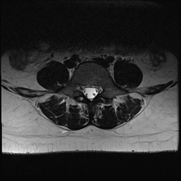 File:Normal lumbar spine MRI- 3 T (Radiopaedia 53280-59250 Axial T2 22).jpg