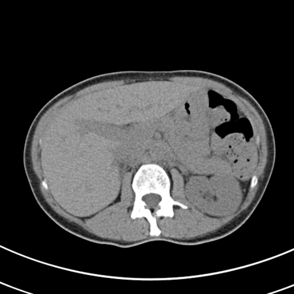 File:Normal multiphase CT liver (Radiopaedia 38026-39996 Axial non-contrast 23).jpg