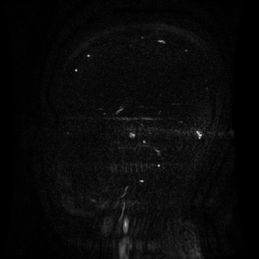 Normal noncontrast MR venography (Radiopaedia 87578-103957 A 58).jpg