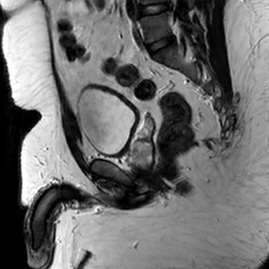 File:Normal prostate (MRI) (Radiopaedia 29986-30535 Sagittal T2 8).jpg