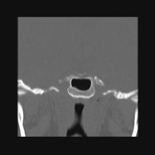 Normal sinus CT (annotated) (Radiopaedia 78917-91810 Coronal bone window 52).jpg