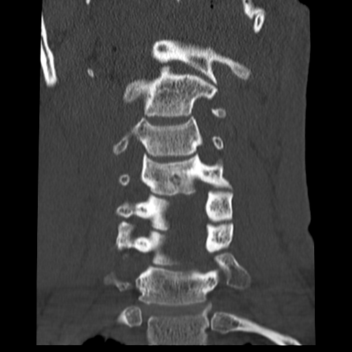 File:Normal trauma cervical spine (Radiopaedia 41017-43760 Coronal bone window 14).png
