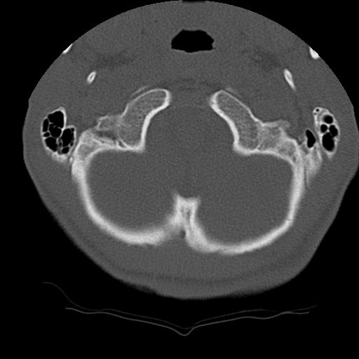 Normal trauma spine imaging (age 16) (Radiopaedia 45335-49358 Axial bone window 4).jpg