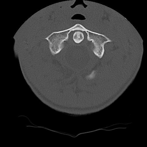 Normal trauma spine imaging (age 16) (Radiopaedia 45335-49358 Axial bone window 9).jpg