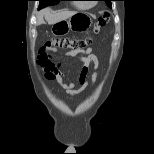 Obstructing renal calculus (Radiopaedia 29517-30016 Coronal non-contrast 11).jpg