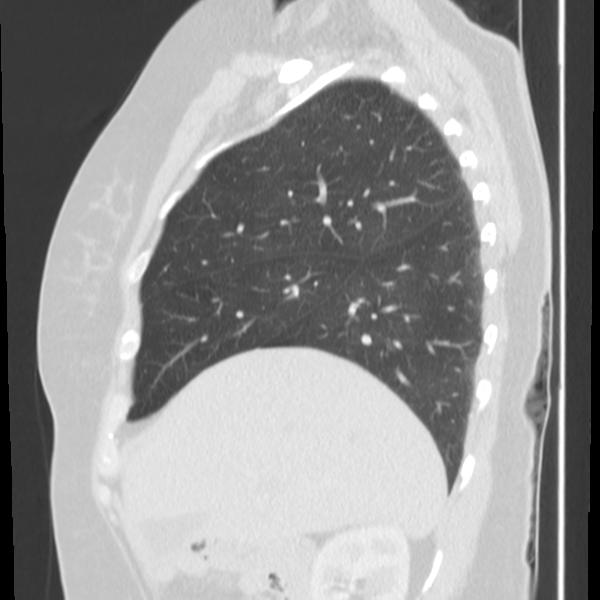Obstructing typical carcinoid causing bronchoceles (Radiopaedia 50149-55476 Sagittal lung window 16).png