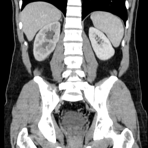 File:Obstructing ureteric calculus (Radiopaedia 18615-18514 C 54).jpg