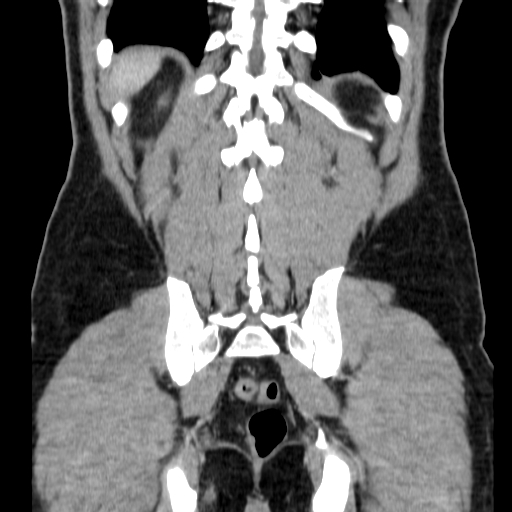 File:Obstructing ureteric calculus (Radiopaedia 18615-18514 C 65).jpg
