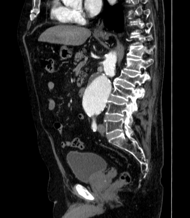 Abdominal aortic aneurysm (Radiopaedia 25855-26001 Sagittal C+ arterial phase 30).jpg