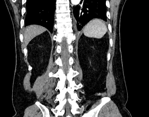 Abdominal aortic aneurysm (Radiopaedia 67117-76452 Coronal C+ arterial phase 87).jpg
