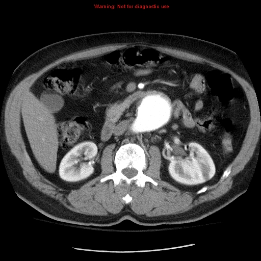 Abdominal aortic aneurysm (Radiopaedia 8190-9038 Axial C+ arterial phase 34).jpg
