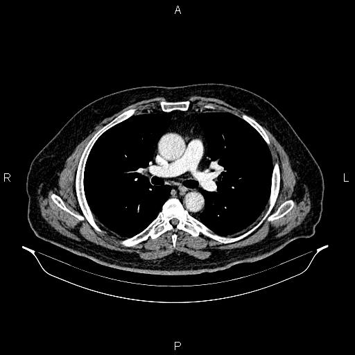 Abdominal aortic aneurysm (Radiopaedia 83094-97462 Axial renal cortical phase 35).jpg