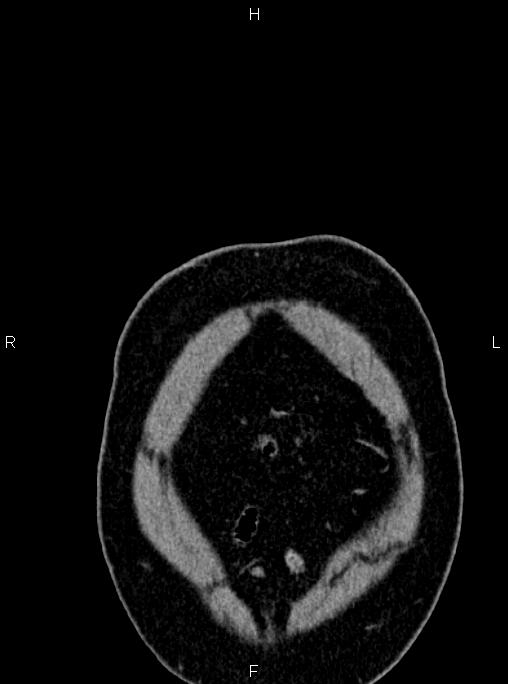 Abdominal aortic aneurysm (Radiopaedia 83094-97462 Coronal renal cortical phase 6).jpg