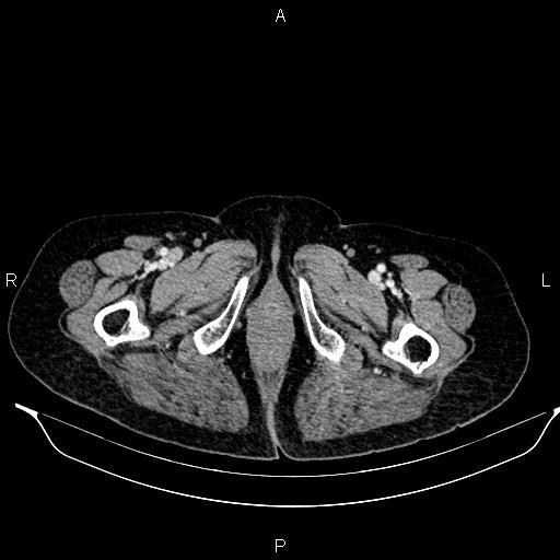File:Abdominal aortic aneurysm (Radiopaedia 85063-100606 Axial C+ portal venous phase 70).jpg
